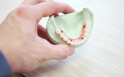 Tout savoir sur les implants dentaires