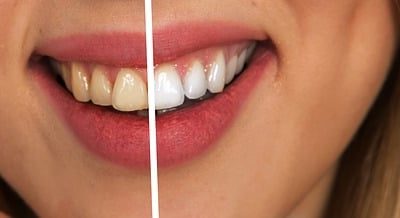 Qu’est-ce que le blanchiment des dents ?