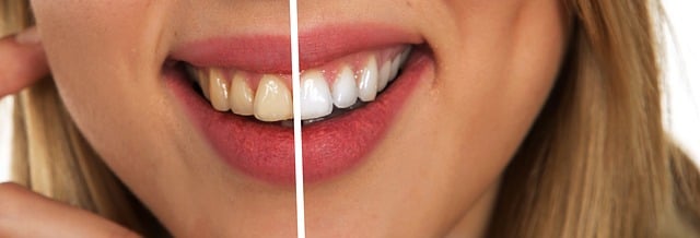 Qu’est-ce que le blanchiment des dents ?